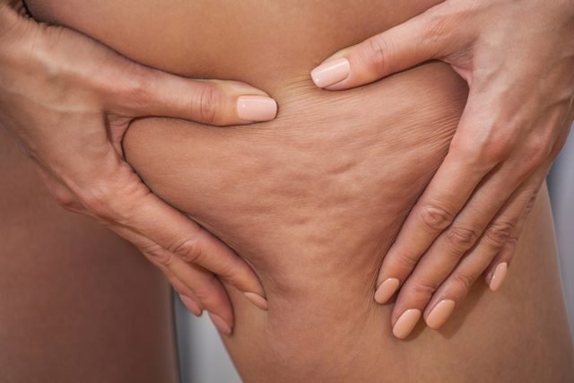 السيلوليت Cellulite… و9 طرق طبيعية لعلاجه