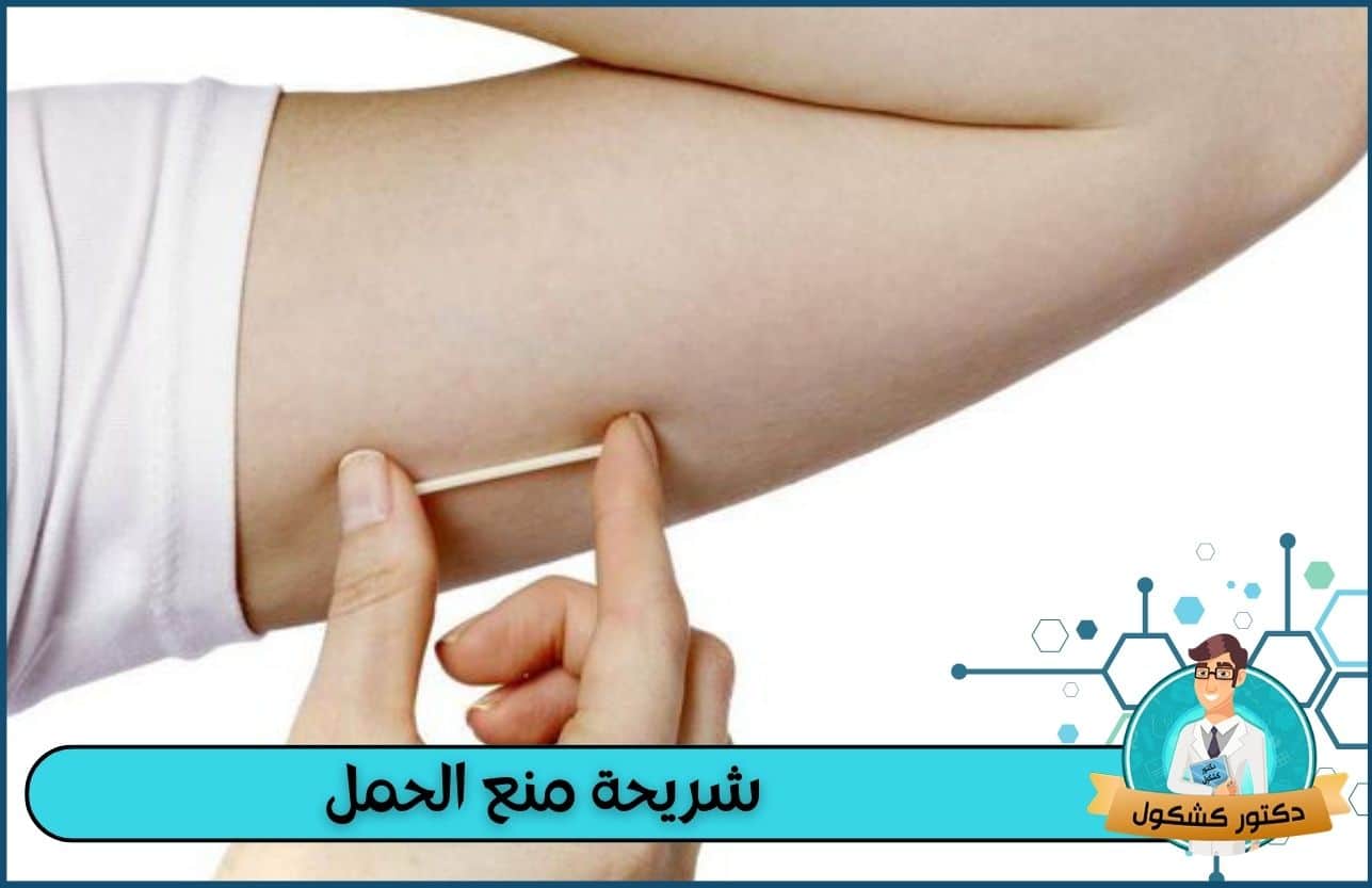 شريحة منع الحمل | مميزاتها وأضرارها وموانع استخدامها